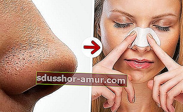 Ogrce na nosu lahko odstranite z moko in medom