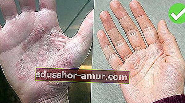 Mâinile cu eczeme pe stânga și mâinile vindecate pe dreapta