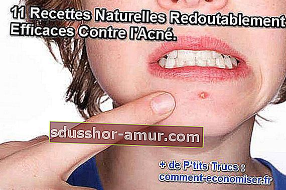 11 rețete naturale pentru acnee