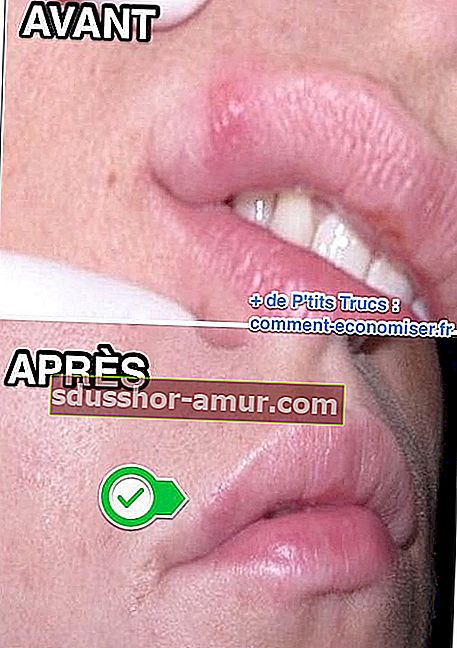 herpes na usnama prije tretmana, a zatim nakon liječenja sodom bikarbonom